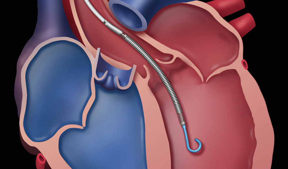 Titelbild: Grafik eines anatomischen Herzens mit Abiomed-Herzpumpe