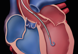 Titelbild: Grafik eines anatomischen Herzens mit Abiomed-Herzpumpe